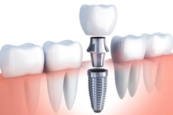 implantes-dentales-1