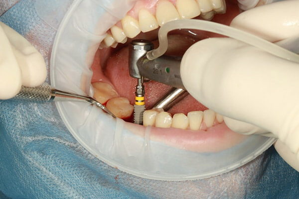 implantes-dentales-2